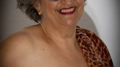 Manoli Castellanos Coello mostrando las tremendas cicatrices de su enfermedad